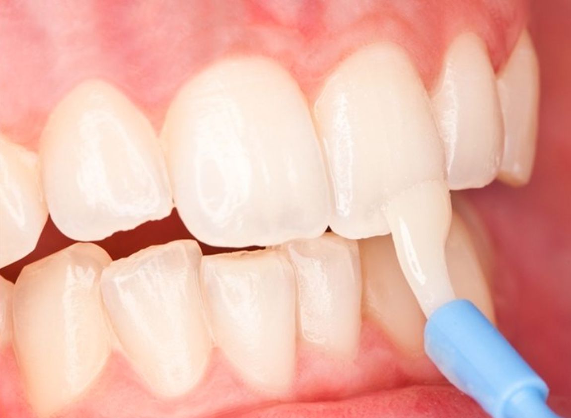 Ngừa sâu răng với flour bôi bề mặt răng
