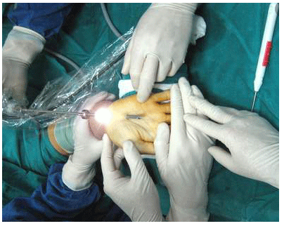 Phẫu thuật nội soi điều trị hội chứng ống cổ tay