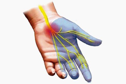 Dấu hiệu Tinel trong chẩn đoán hội chứng ống cổ tay