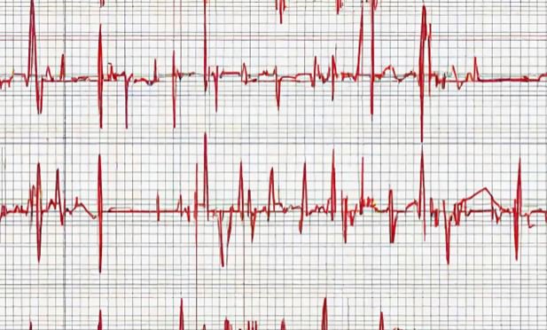Nhịp tim không đều là một trong những triệu chứng của bệnh mạch vành